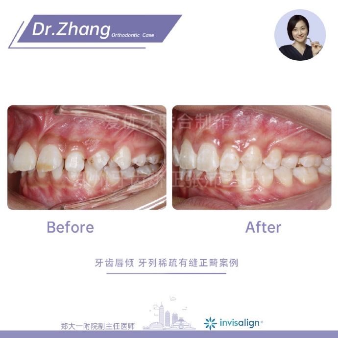 牙齿矫正郑州,郑州牙齿矫正案例合集