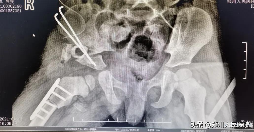 走路像鸭子一样摇摆,走路像鸭子的样子