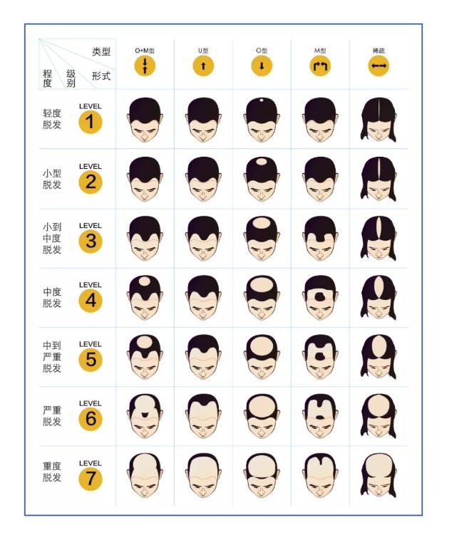 来，对照脱发等级图，你属于几级脱发了？应该如何补？