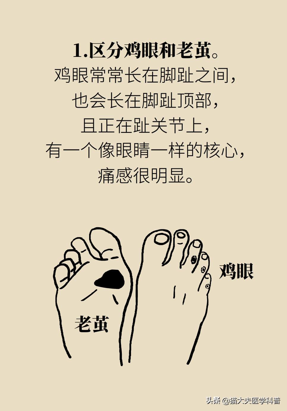 鸡眼好了长了一层老茧,鸡眼与老茧的区别图片