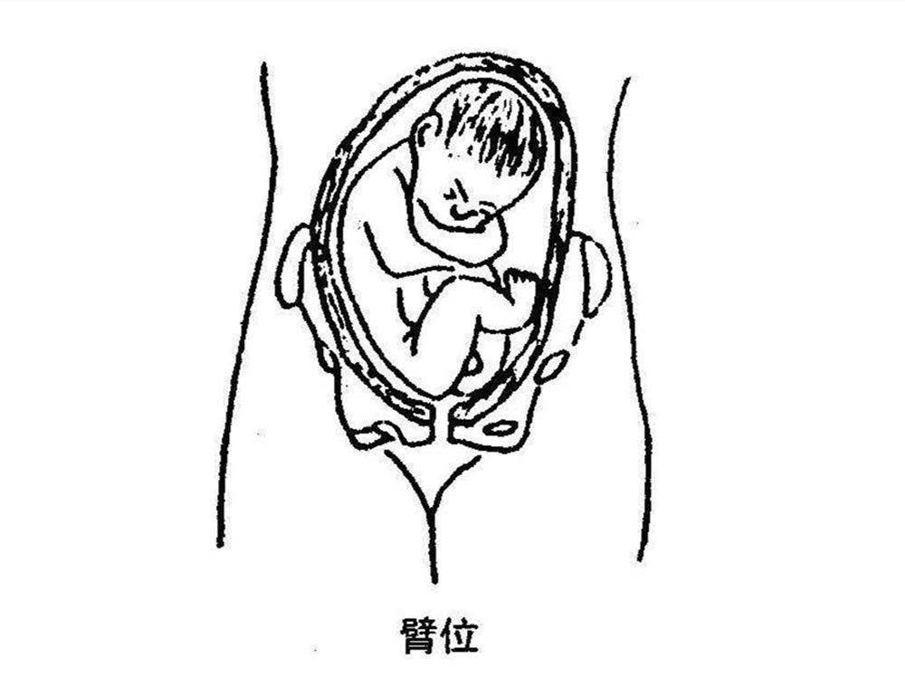 为什么会形成胎儿臀位？如何纠正？不妨学学这两个小技巧