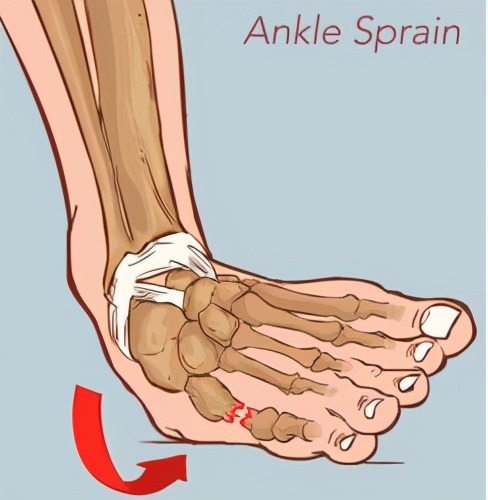 WildFieldHealth|如何解决习惯性崴脚？