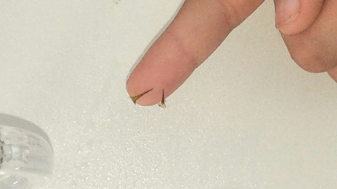 手指头扎刺很深没有刺尾取出妙招,手指头扎刺怎么弄出来不用白醋