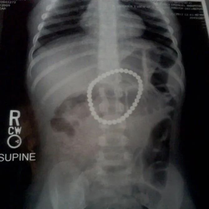 曾有女童误食磁力珠致14处肠穿孔,12岁男孩误食8个磁力珠致肠穿孔