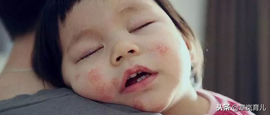 脸上湿疹涂了有激素的药膏怎么办,宝宝湿疹老是反复妈妈要忌口吗