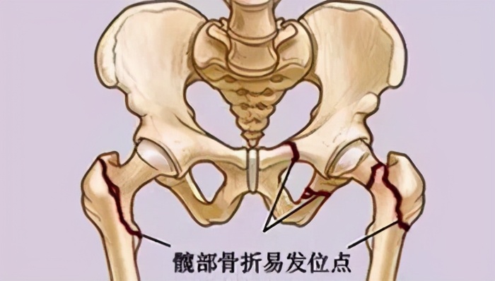 这种骨折致残率、死亡率高到难以想象！全球30%发生率在中国