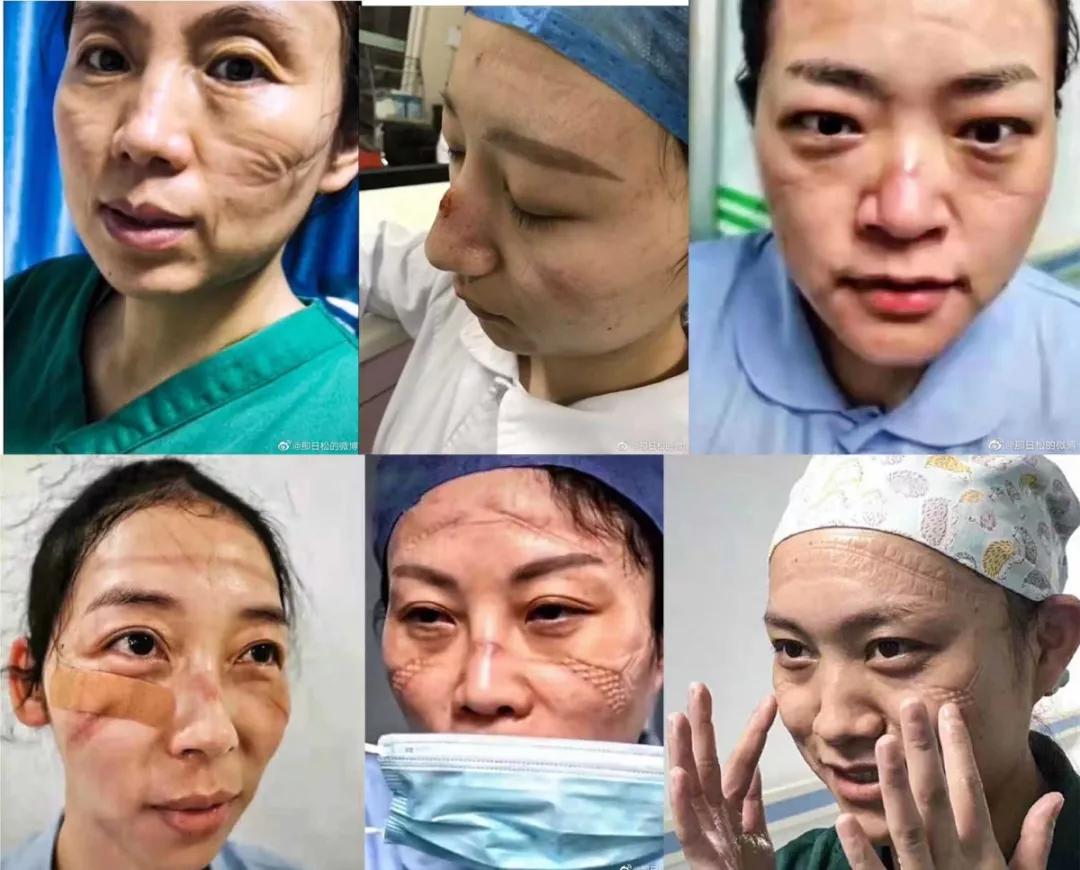 抗肺炎医生：我也怕死，但忙着救人，我忘记了害怕