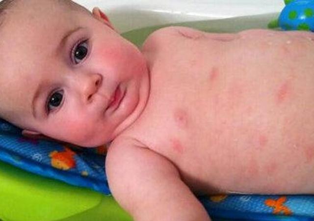 宝宝湿疹破皮可以用修复霜修复吗,宝宝湿疹破皮了是快好了吗