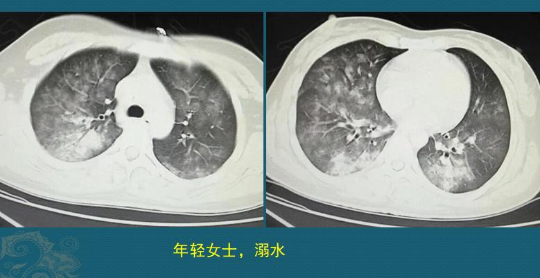 溺水后肺里有积水吗,溺水后肺里的水会出来吗