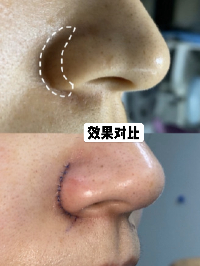 鼻翼缩小可以单独做吗,内切鼻翼缩小有效果吗