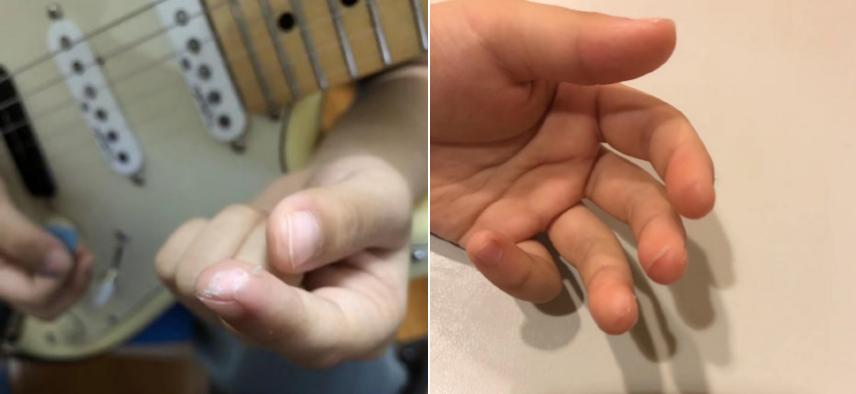 6岁小女孩手上全是血泡老茧：哪来的一夜成名，还不是百炼成钢