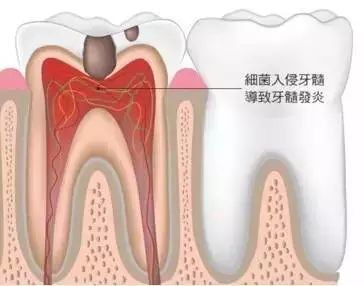 牙痛不能忽视,这类牙疼要警惕