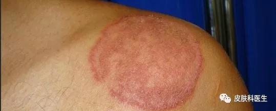 关于体癣与股癣的诊疗，皮肤科专家达成的共识