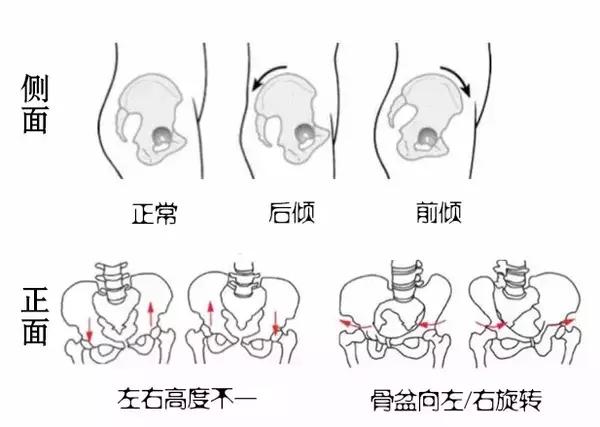 骨盆歪斜的危害,骨盆歪斜和骨盆扭曲