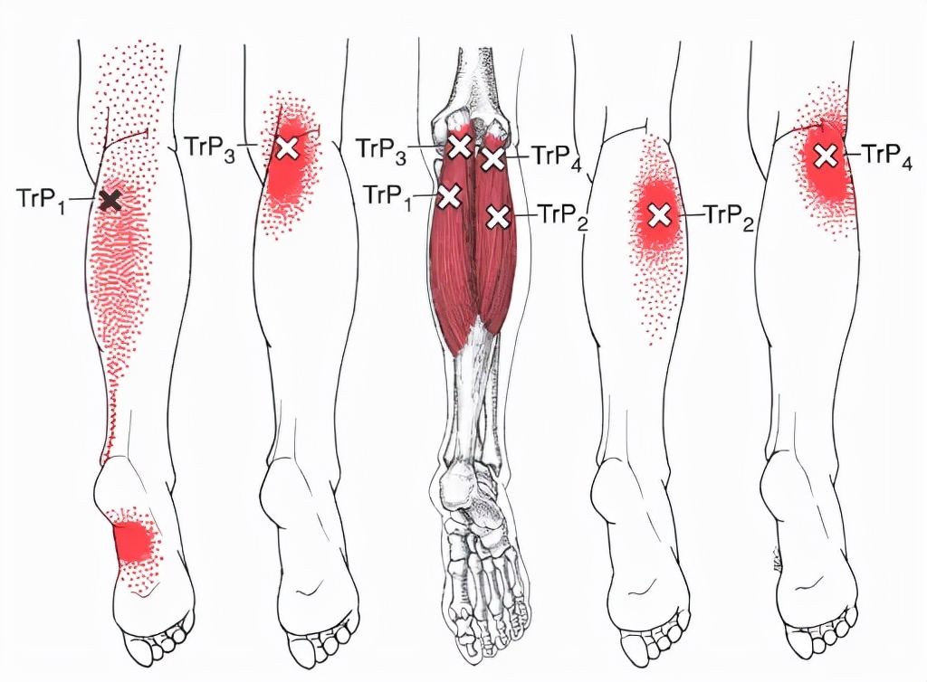 小腿内侧肌肉疼康复训练,拉伸腓肠肌小腿前侧痛原因