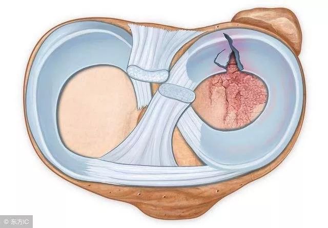 半月板被切除80%,半月板切除后还剩4分之一严重吗