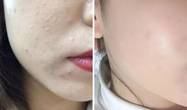 闭口粉刺去美容院清闭口好吗,如何正确去除粉刺闭口