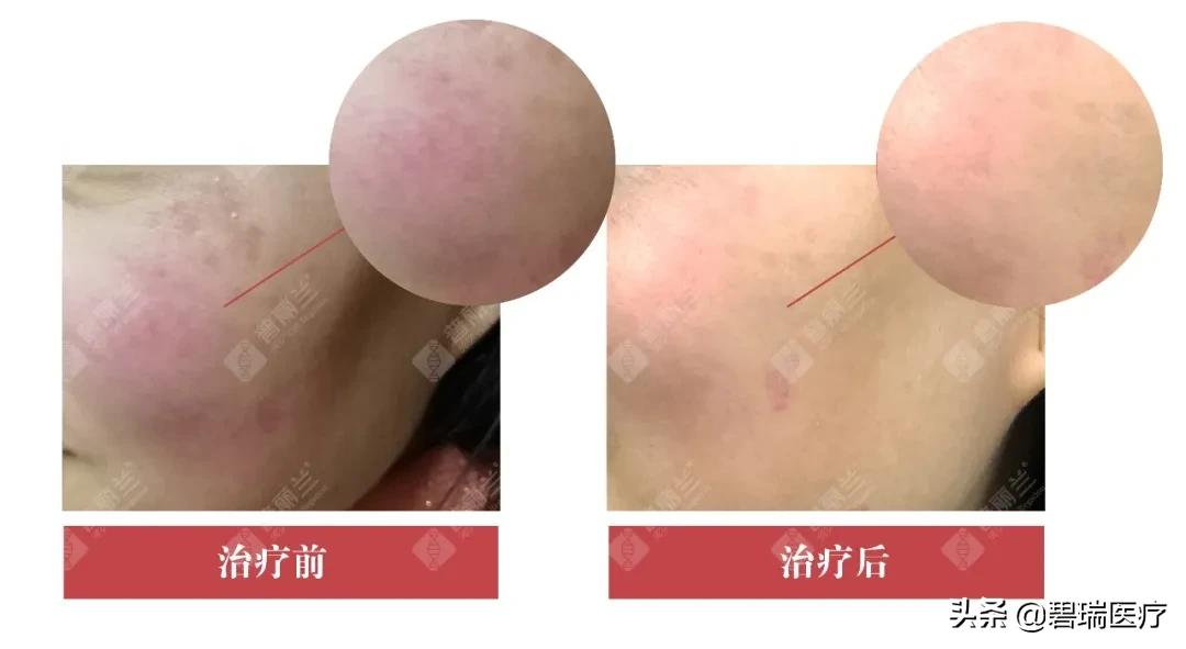 普丽兰pdrn再生2.0,普丽兰pdrn三重作用