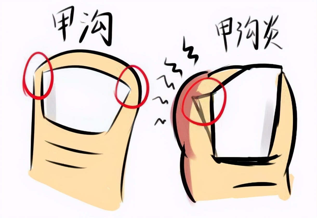 甲沟炎有什么需要关注的事项,甲沟炎恢复过程中会遇到的问题