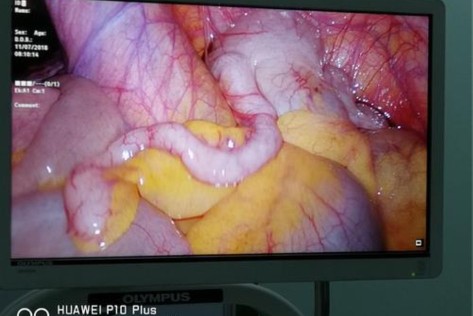 阑尾切除手术费用多少钱,阑尾切除手术记录模板