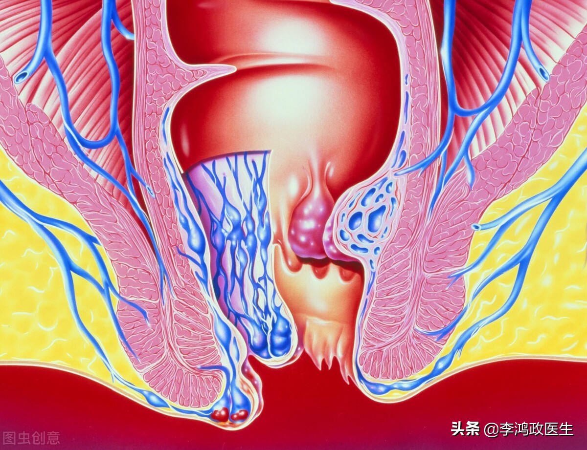 女性臀部反复长疙瘩,屁股肉疙瘩手术治疗全过程
