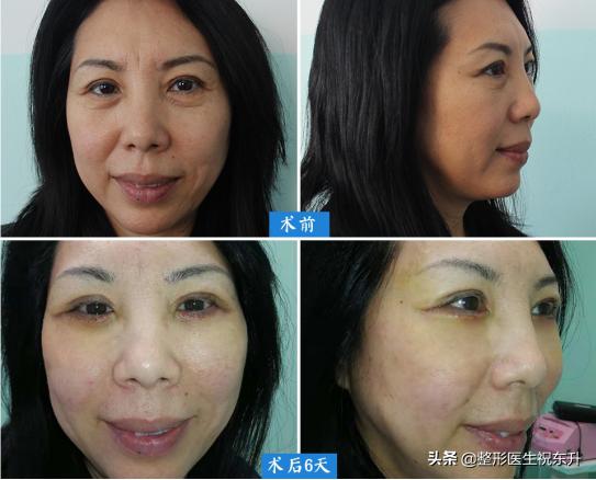 下眼皮下垂松弛可以打针吗,下眼皮睁不开是怎么回事