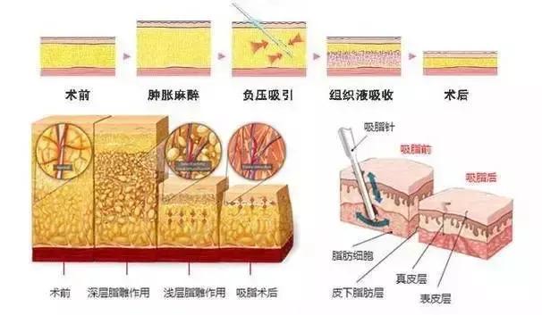 你不知道的吸脂后遗症都有哪些,吸脂你不懂的一些知识