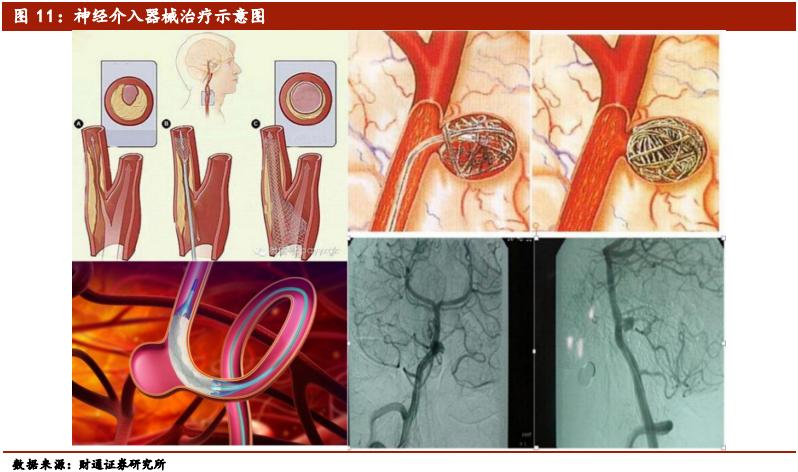 介入类医疗器械公司排名,医疗介入器械