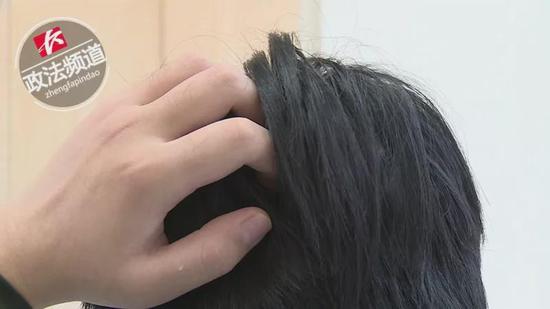 精神长期高度紧张导致斑秃,12岁的男孩沉迷于游戏怎么办