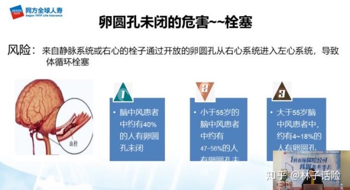 宝宝卵圆孔未闭合可以买保险吗,宝宝卵圆孔未闭可以买重疾险吗