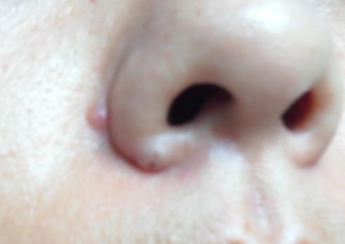 脸上老是长痘怎样内调,脸上老是长痘怎么办小妙招