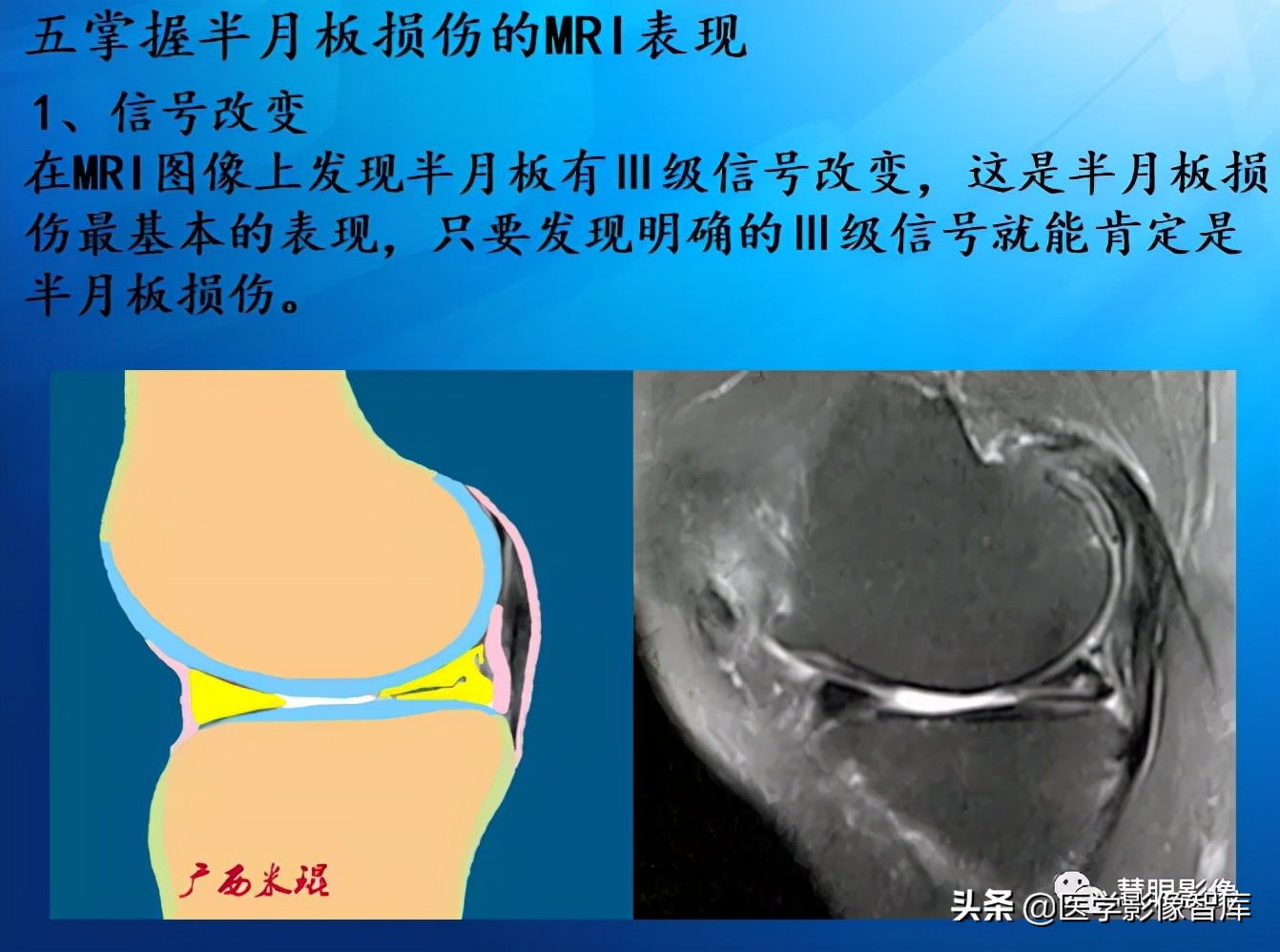 膝关节半月板损伤的解剖结构图,半月板mri解剖图解