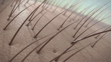 头皮毛囊炎一定要重视，不然一不谨慎就秃头，假发也救不了你