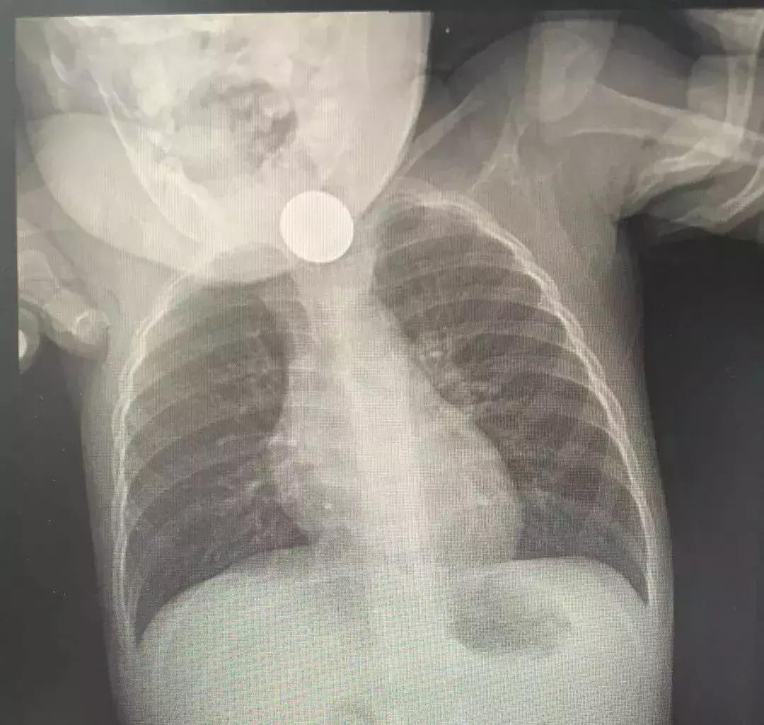 小孩先天性食道被塞什么引起的,一岁女童胃部被撑破