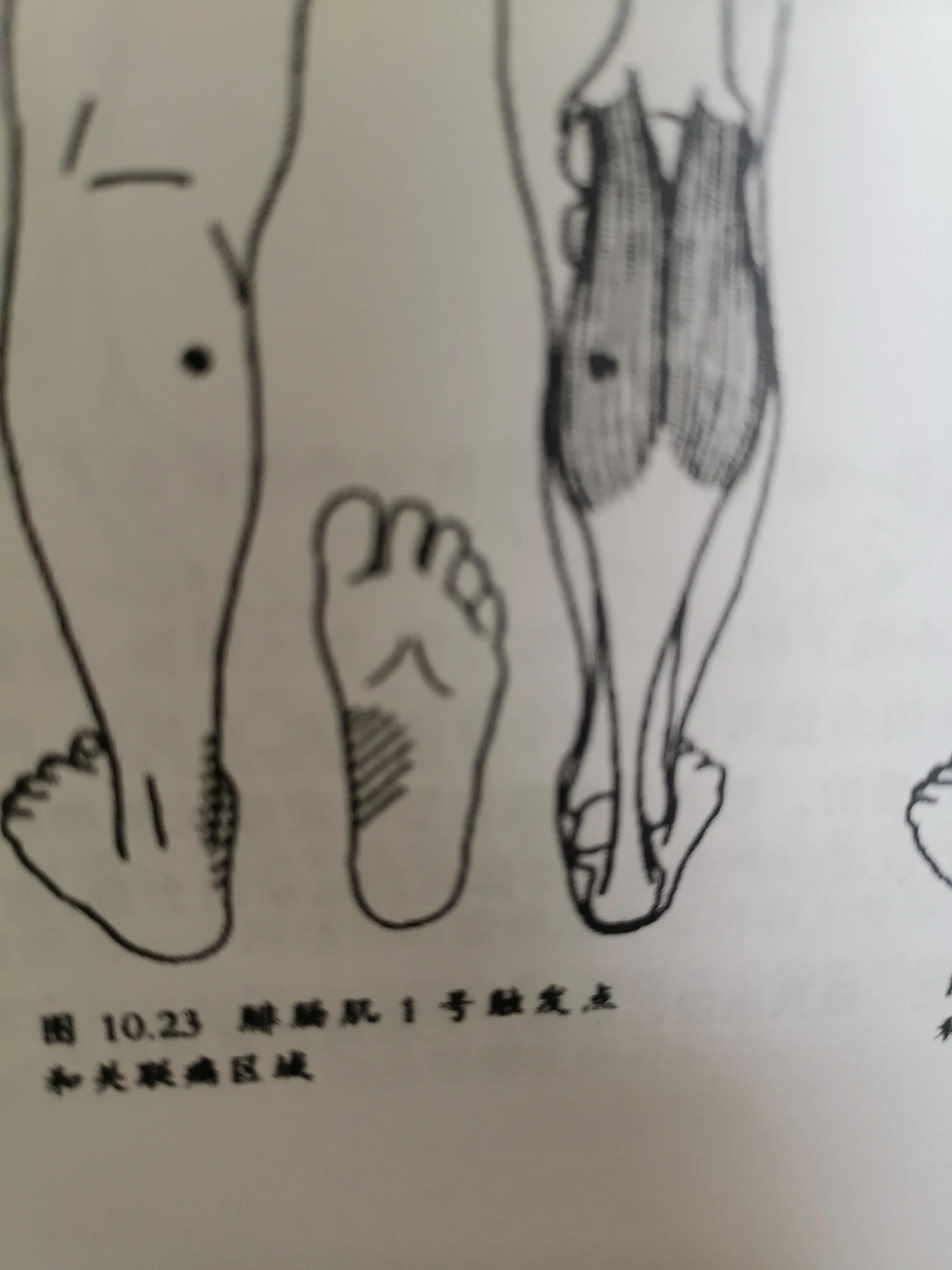 跟腱炎的自我治疗方法,跟腱炎最佳的物理疗法