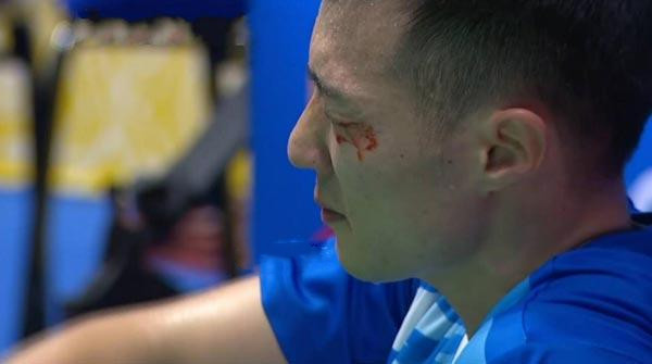 眼睛让羽毛球打中了该怎么办,羽毛球眼睛受伤视频