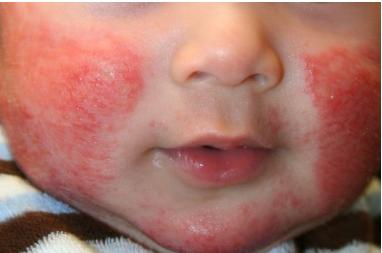 皮炎湿疹口服特效药,皮炎湿疹特效药试用装