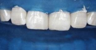 门牙裂了一条缝,门牙有缝的女人