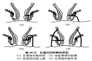 什么是肛瘘？人为什么会得肛瘘？如何诊断肛瘘？肛瘘要做哪些检查