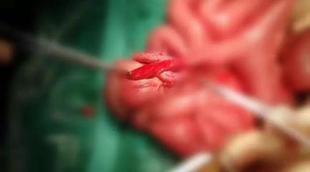 小儿梅克尔憩室炎不便血,蛋白质过敏宝宝便血